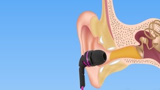 Wearing ear buds in the summer could give you a nasty infection that swimmers dread screenshot 2