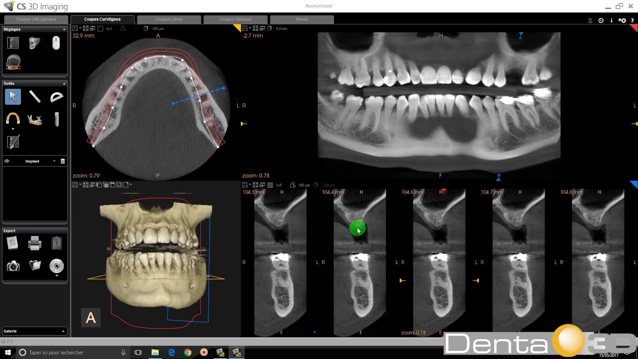 CS 3D Imaging - Bibliothèque d'implants