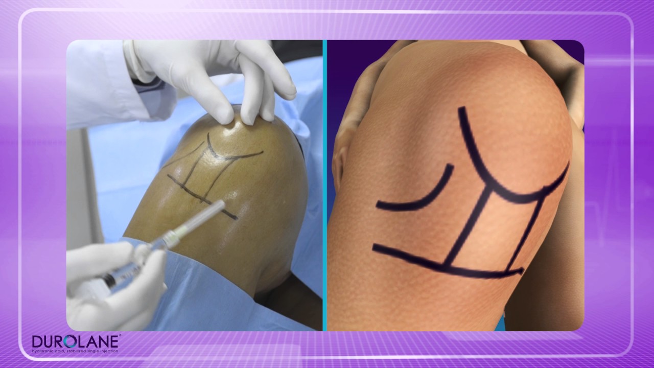 TÉCNICA DE INFILTRACION DE  RODILLA PORTAL LATERAL