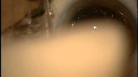 Secure fixation of an IOL with the optic capture technique