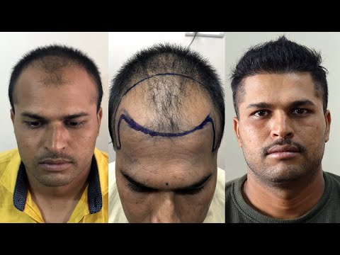 safe-hair-transplant-result-2019-|-best-fue-hair-transplant-result-in-india-|-new-roots-hair-clinic