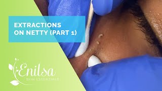 Blackheads... and more blackheads! Netty's First Treatment