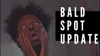 Bald Spot update using The Hairchanic Octane Drops