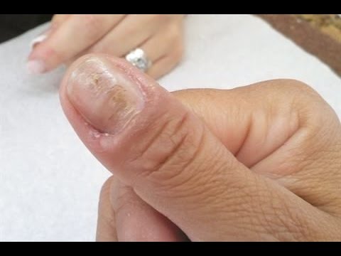 What Causes Of Ridges In Your Finger And Toenails Here Are The What Causes Of Ridges In Your Finger And Toenails Here Are The Answer