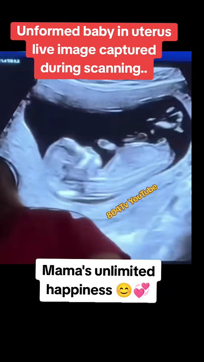 unformed baby in uterus live image captured during scan|#pregnancy #baby
