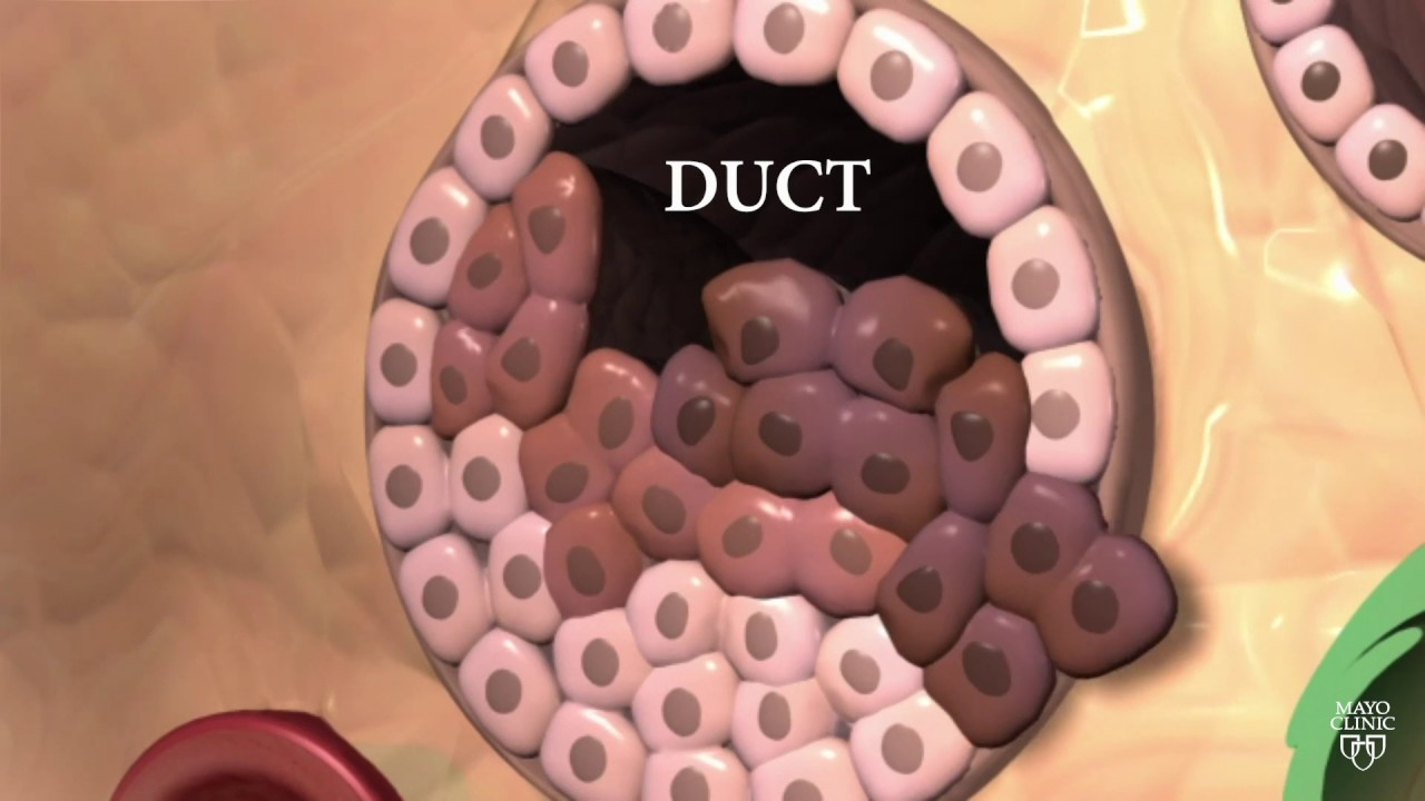 Malignant Papilloma Breast Mednews Ro