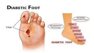 Paa Ng May Diabetes - Ni Doc Willie At Liza Ong