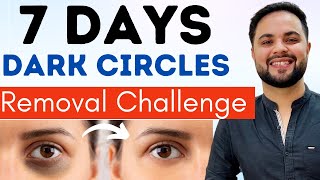7 Days Dark Circles Removal Challenge || Permanent Treatment