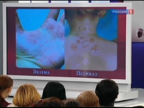Экзема: симптомы, причины и лечение. Стадии и варианты лечения экземы