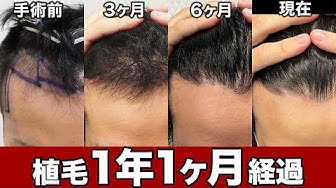 植毛 Youtube