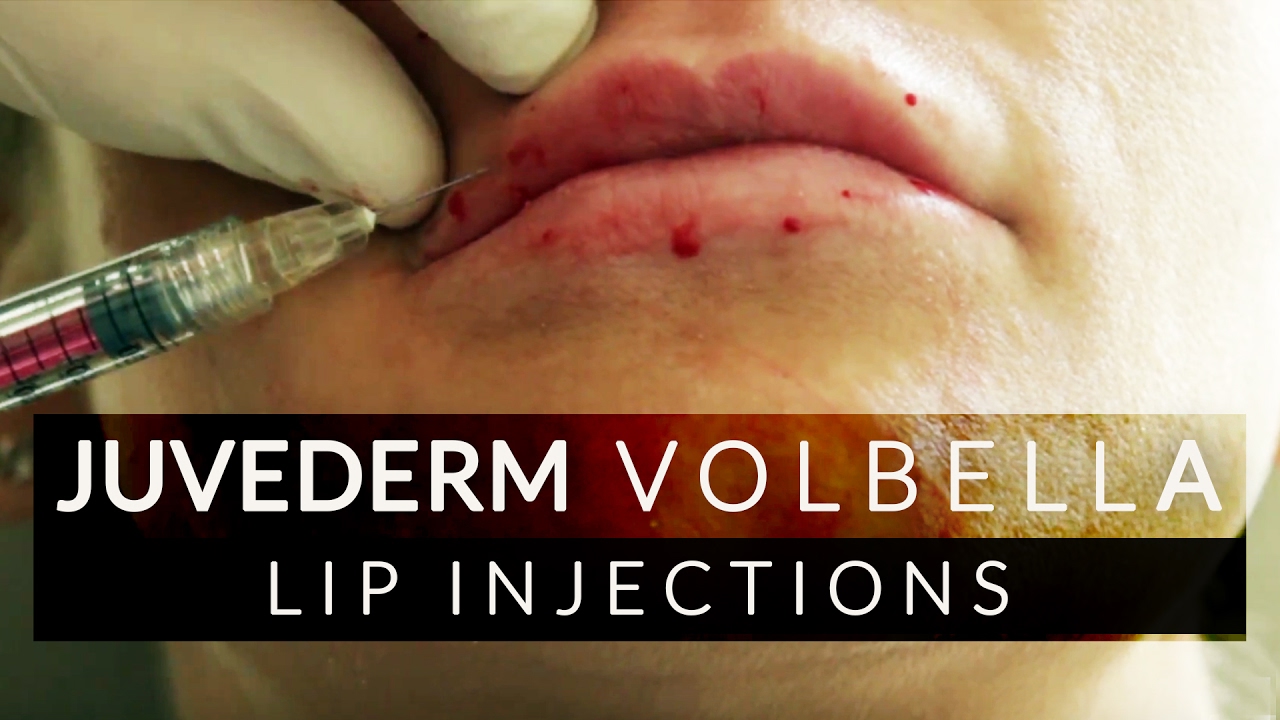 Lip Filler Juvederm Volbella Treatment YouTube