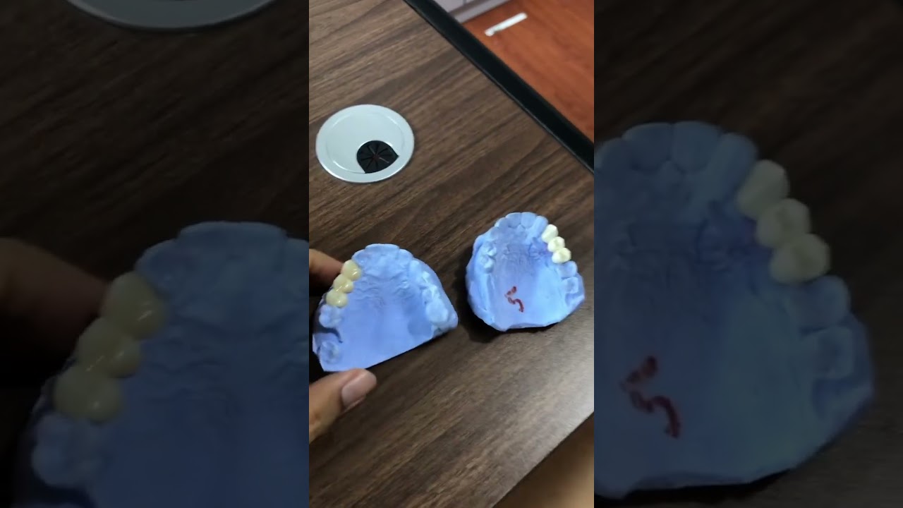 Perbedaan Gigi Palsu Jembatan Zirconia dgn PFM