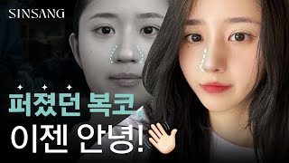 [리얼모델] 자연스럽게 정돈된 코 라인, 복코 수술 후기👃💖
