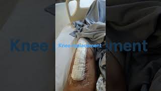 Knee Replacement