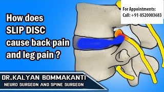 How does SLIP DISC cause back pain and leg pain ? - Best Endoscopic Spine Surgeon in Hyderabad screenshot 5