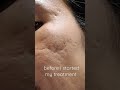 Amazing change  microneedling  4th treatment  4 days after treatment  acne journey   hherman