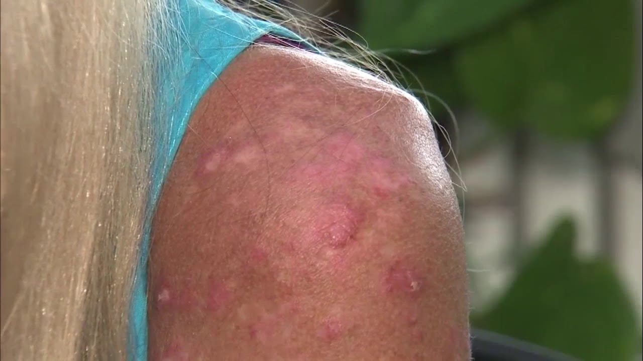 Laguna Niguel Woman Denied Manicure At Hy Nails Over Lupus Scars Laguna Niguel Woman Denied Manicure At Hy Nails Over Lupus Scars Company Responds