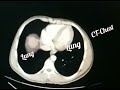 abdominal CT-scan