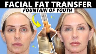 BIGGEST Facial Fat Transfer Myths!