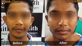 projected ear surgery india  Bhubaneshwar kolkata hyderabad banglore raanchi  Gwalior Jabalpur