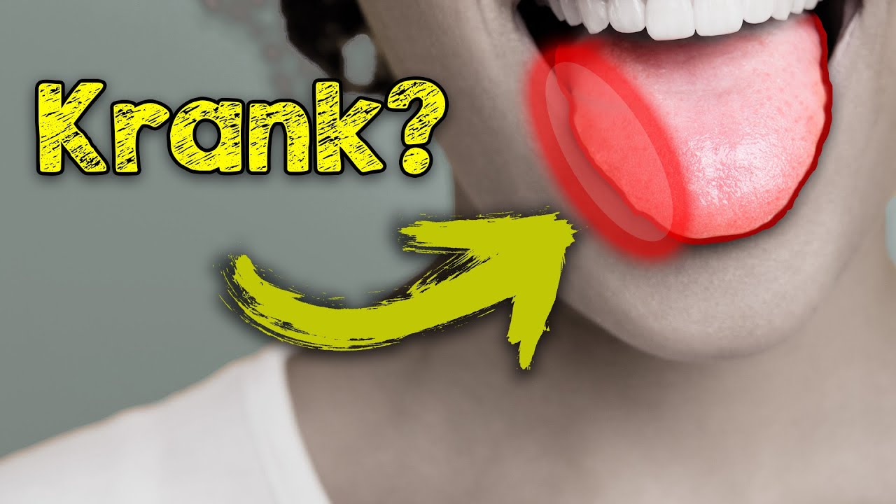 Zunge Verschluckt Wie Sieht Das Aus Deine Zunge sieht so aus? Das bedeutet es für deine Gesundheit - YouTube