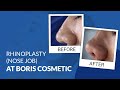 Rhinoplasty nose job at boris cosmetic