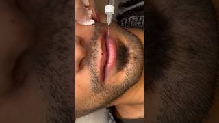 Arab Man Lip Filler 2023