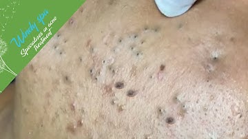 (Acne Treatment for Hung P2) - Make Your Day Relaxing with Windy Spa 6#200