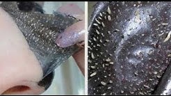 mencabut komedo dengan bahan alami - Durasi: 2.44. mencabut komedo dengan bahan alami - Durasi: 2.44.