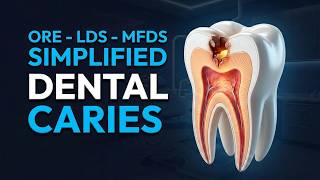 Dental Caries - Simplified Revision for ORE LDS MFDS - Pink Book Oxford Handbook