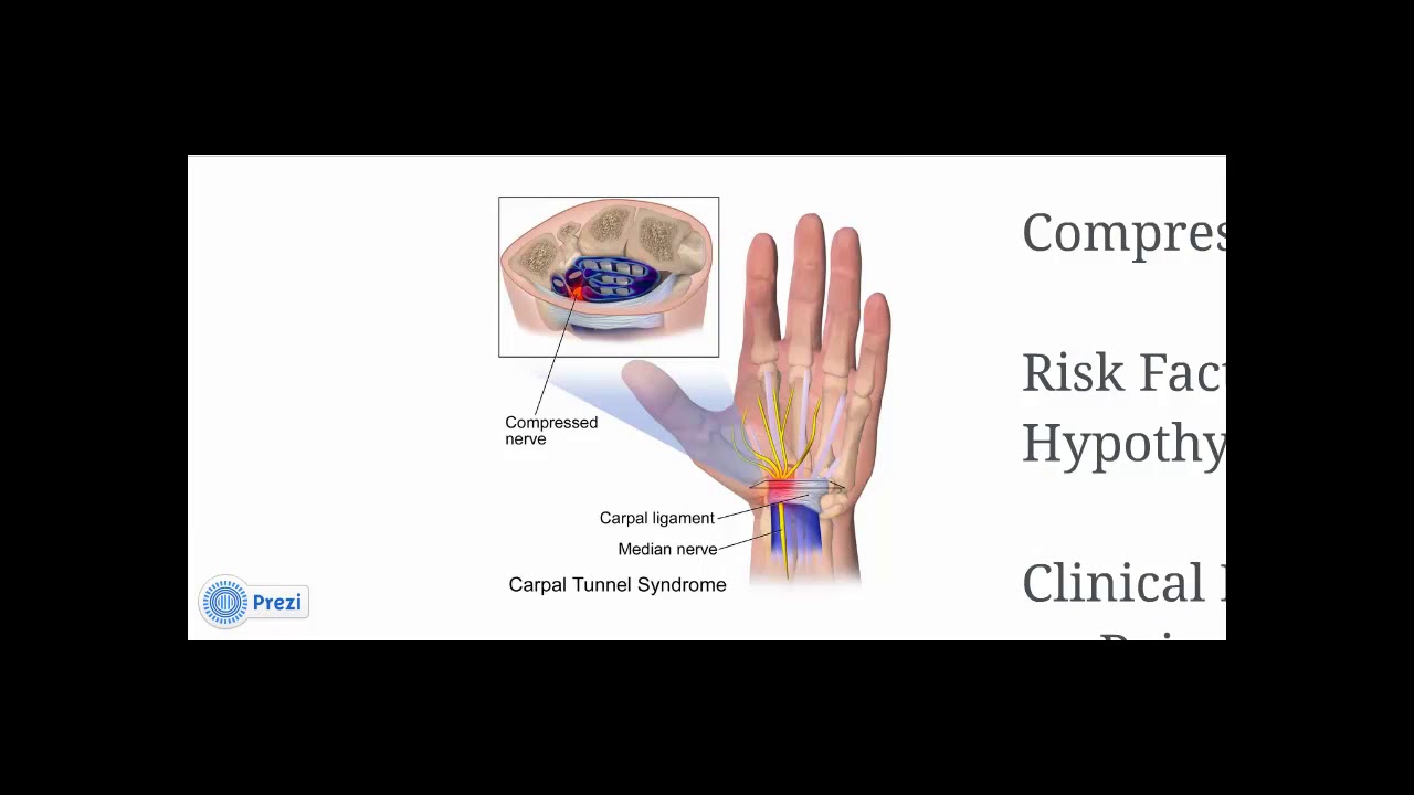 Neurology - mononeuritis