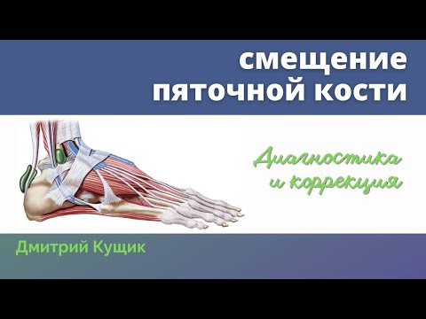 СТОПА | Смещение пяточной кости | Визуальная диагностика и коррекция Кинезиология | Дмитрий Кущик