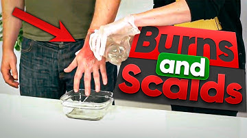 Burns and Scalds - First Aid Training