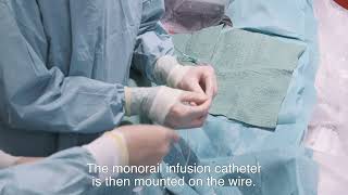 An Introduction To Mrr With Rayflow Hexacath