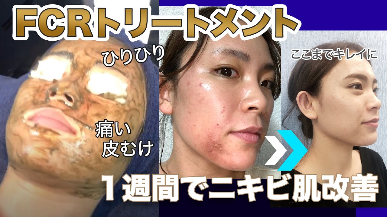 剥離あり ハーブピーリングってニキビよくなるの？ - YouTube