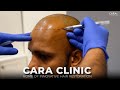 Cara hair transplant  home of innovative hair restoration