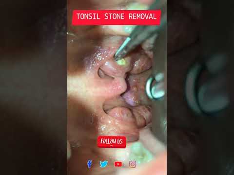 #shorts #youtubeshorts #tonsilstones  Tonsil Stone Removal