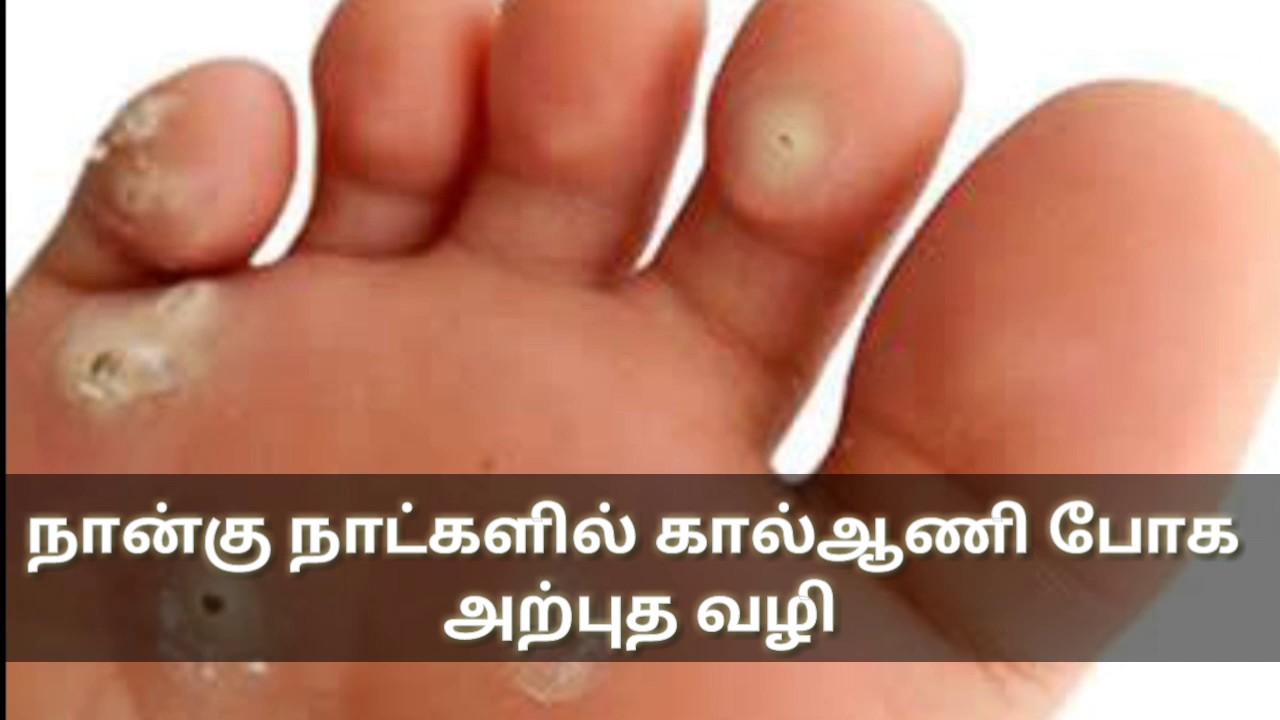 நான்கு நாட்களில் கால்ஆணி போக அற்புத வழி(HOW TO GET RID OF FOOT CORN IN