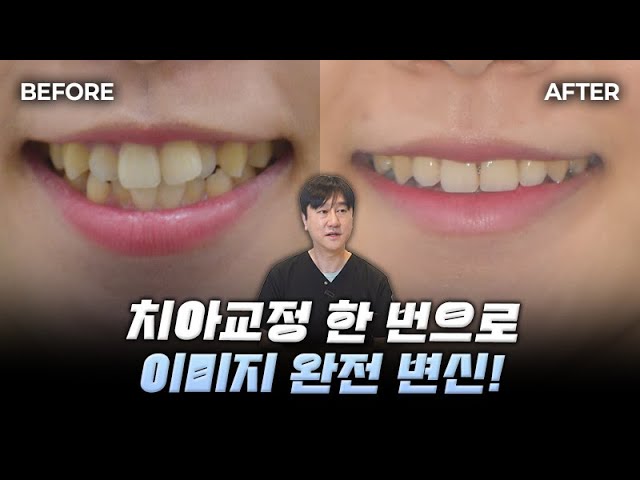 덧니돌출입교정, 얼굴변화 있을까? (치아교정전후, 발치교정🦷)