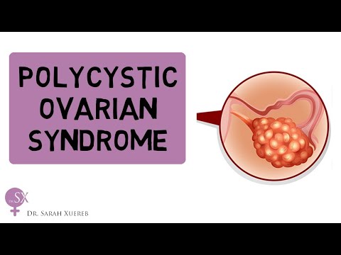 ቪዲዮ: የ polycystic ovary syndrome (PCOS) ን ለማስተዳደር 3 መንገዶች