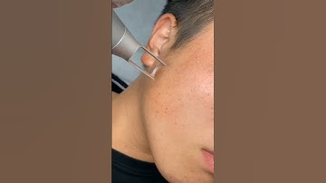 Super picosecond freckle - immediate effect.#picolaser #picosurelaser#picosecond #pico#picoway