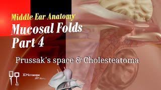 Prussak's space and Cholesteatoma - Middle Ear Anatomy - Mucosal Folds Part 4 screenshot 3