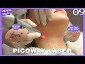 [MyVenus] Kulit Mulus Tanpa Noda dengan Picoway Laser 🔫