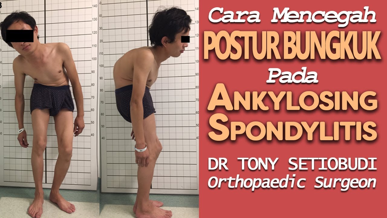 CARA MENCEGAH POSTUR BUNGKUK PADA ANKYLOSING SPONDYLITIS