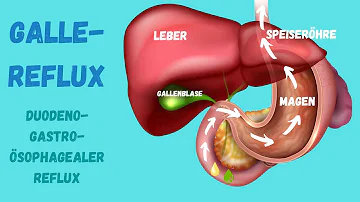 Was kann man gegen Gallereflux machen?