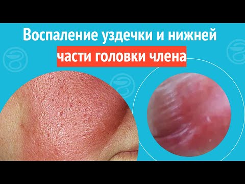 Разрывы влагалища и другие травмы женских половых органов - виды и терапия Разрывы влагалища и другие травмы женских половых органов - виды и терапия