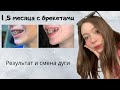 1,5 МЕСЯЦА НОШЕНИЯ БРЕКЕТОВ/ Результат и смена дуги/ Мои ощущения