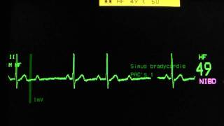 sinus rhythm, second degree AV block type I, Wenkebach on an ECG heart monitor