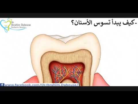 كيف يحدث تسوس الأسنان      