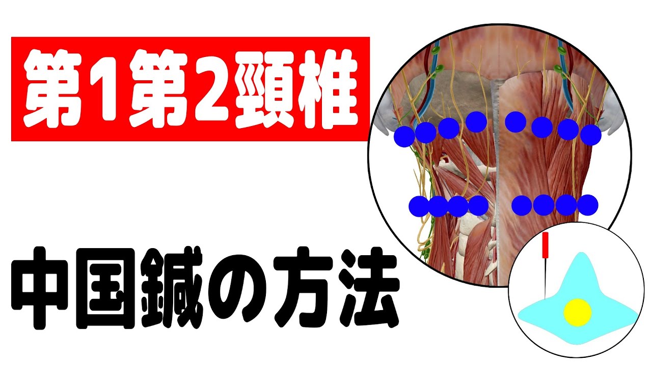 後頭下筋群（第1・第2頸椎）の中国鍼の方法（後頸上部の深鍼） - YouTube